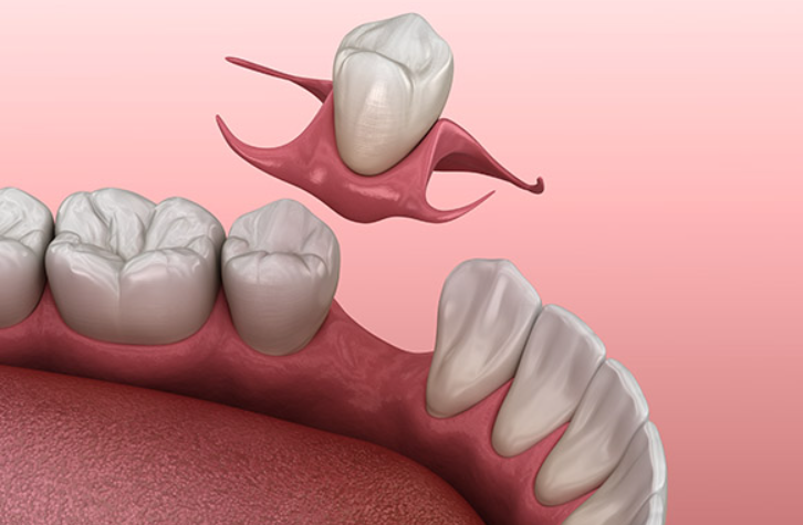 How long does a dental crown take?