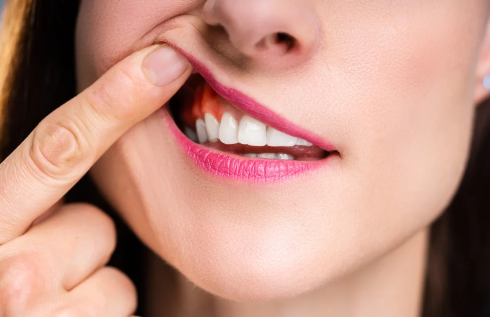Upper denture implants