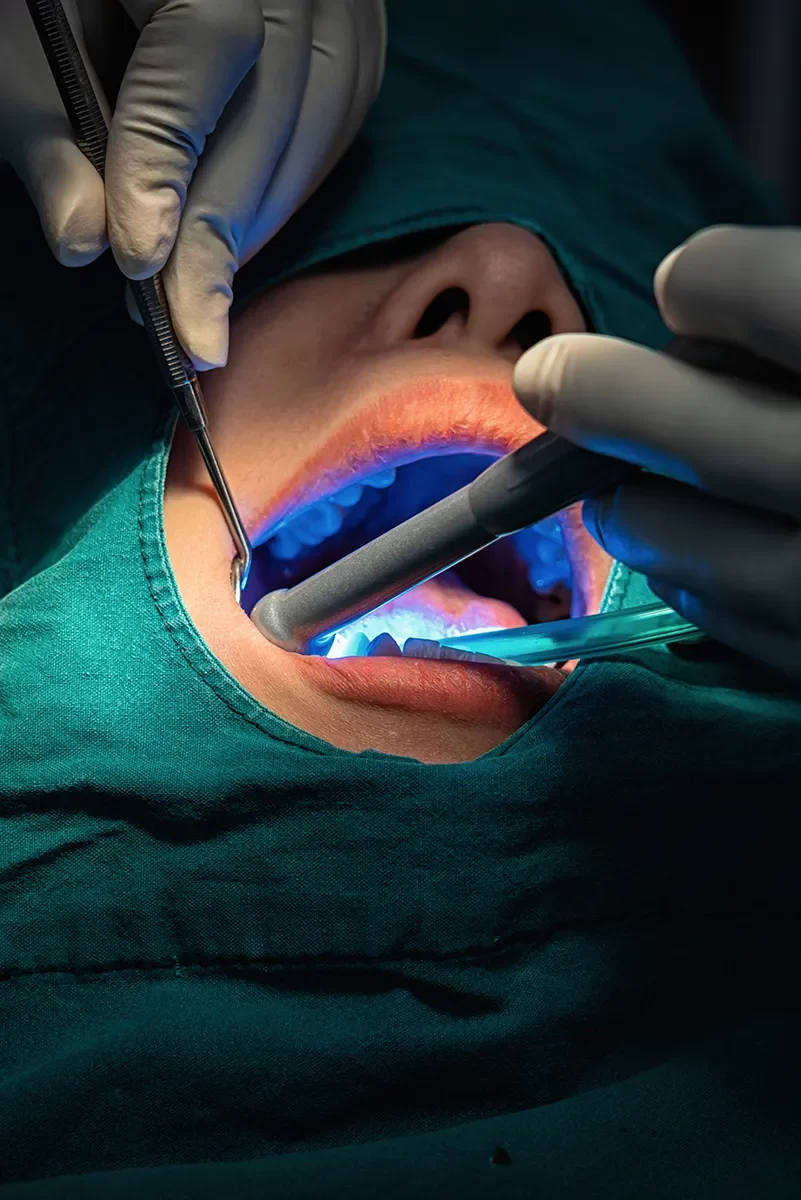 Bone Grafting