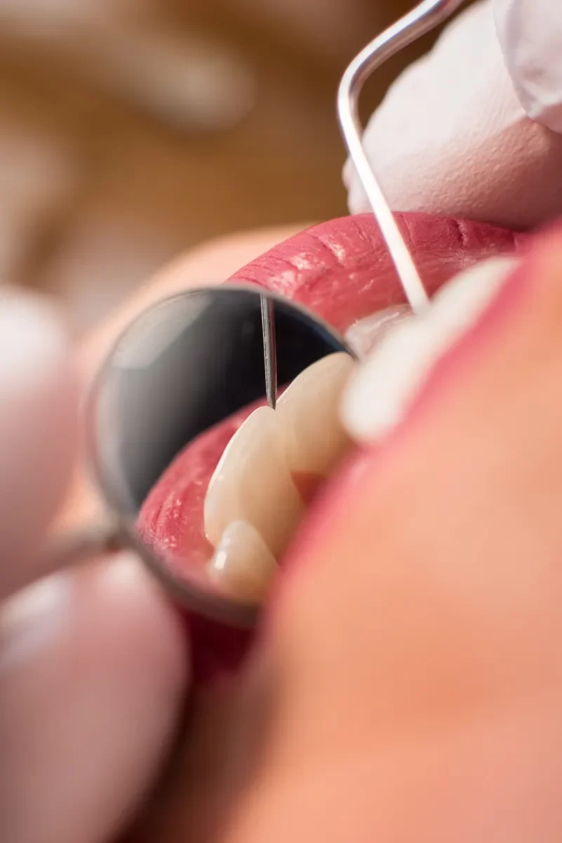 Dental Bridges