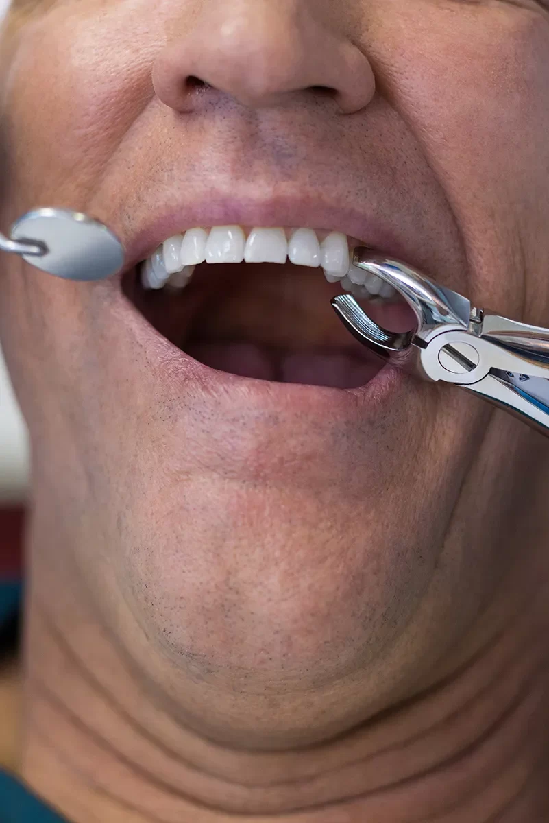 Dental Extraction