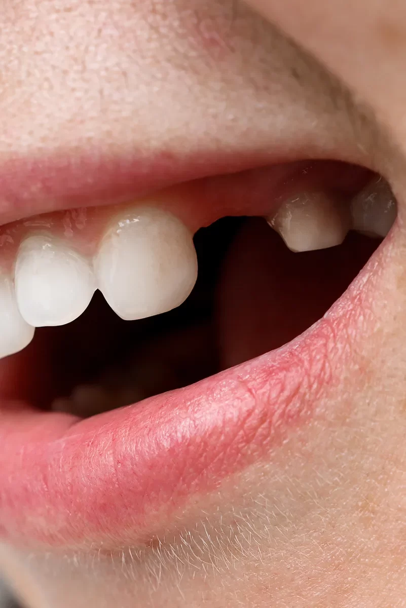 Dental Extraction