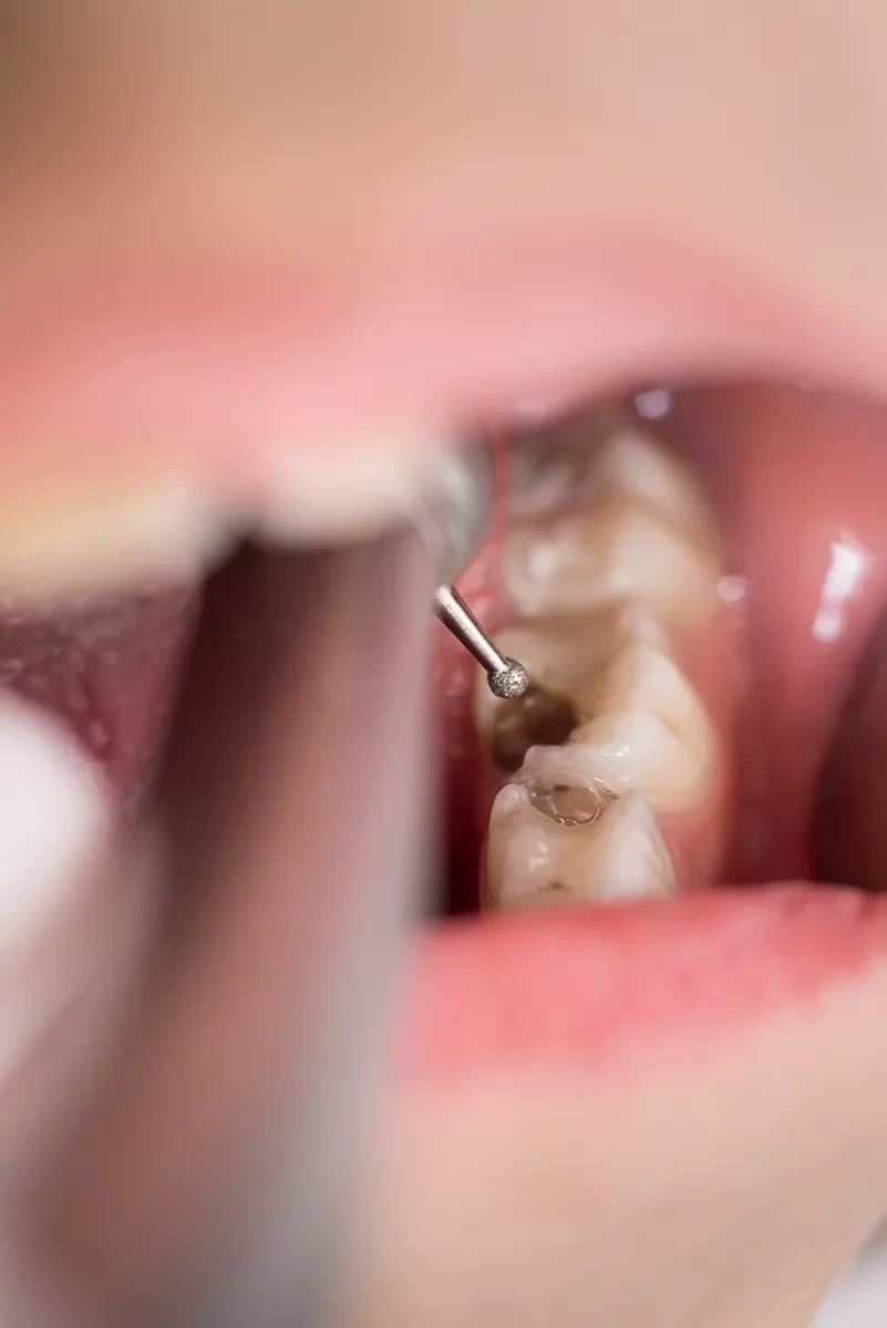 Dental Fillings
