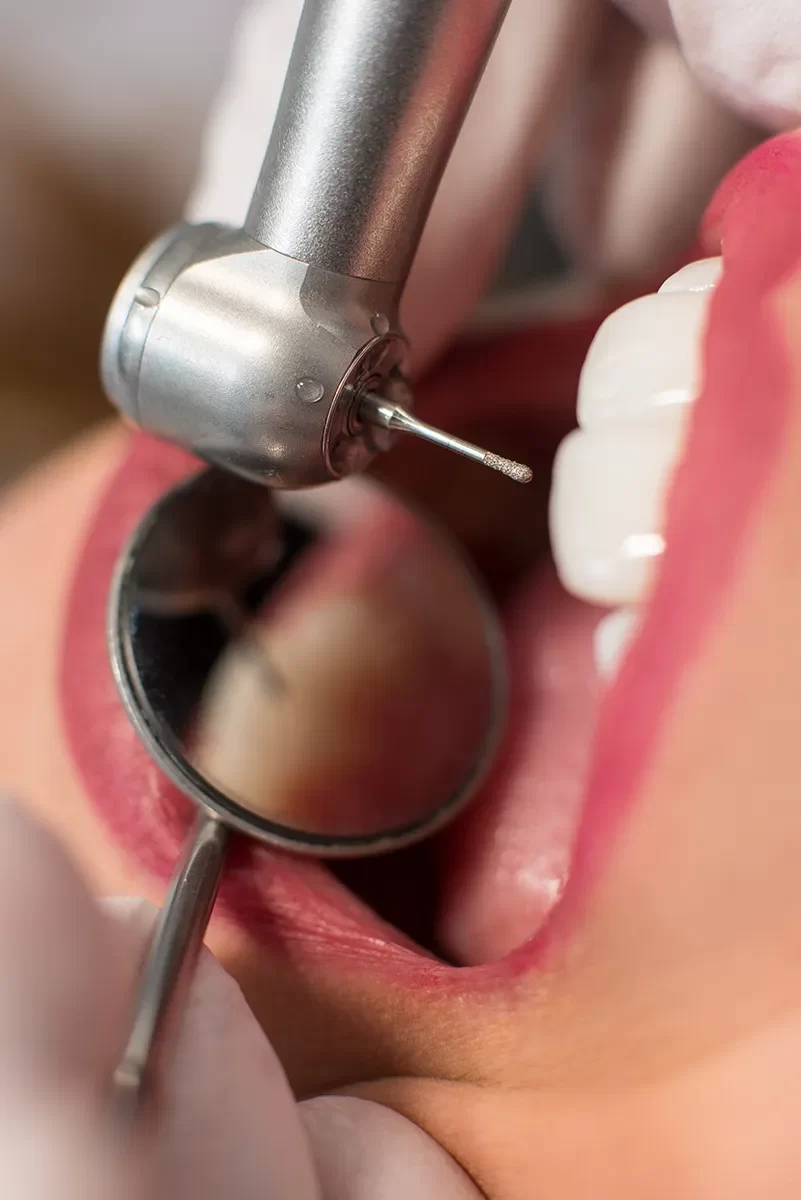 Dental Sealants