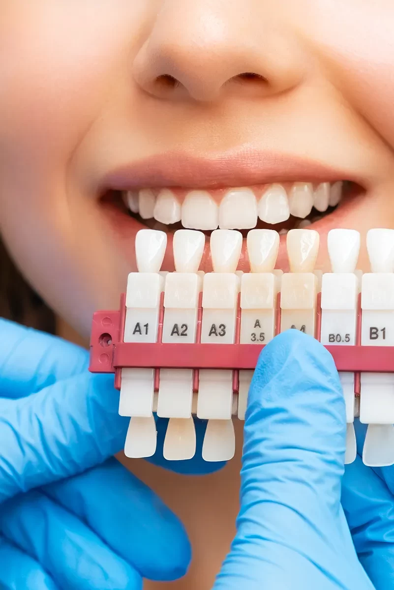 Dental Veneers