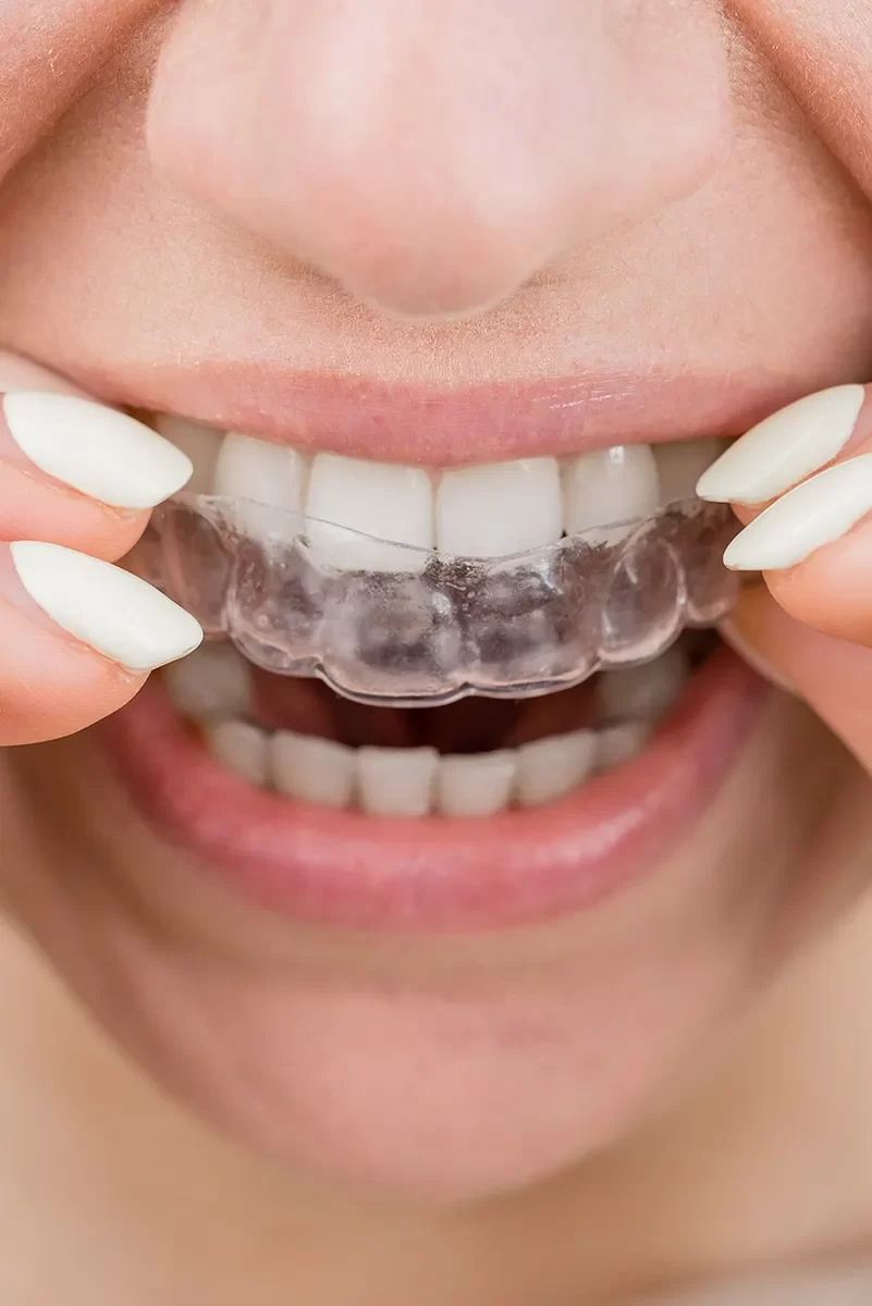 Invisalign