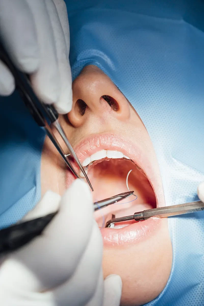 Oral Surgery