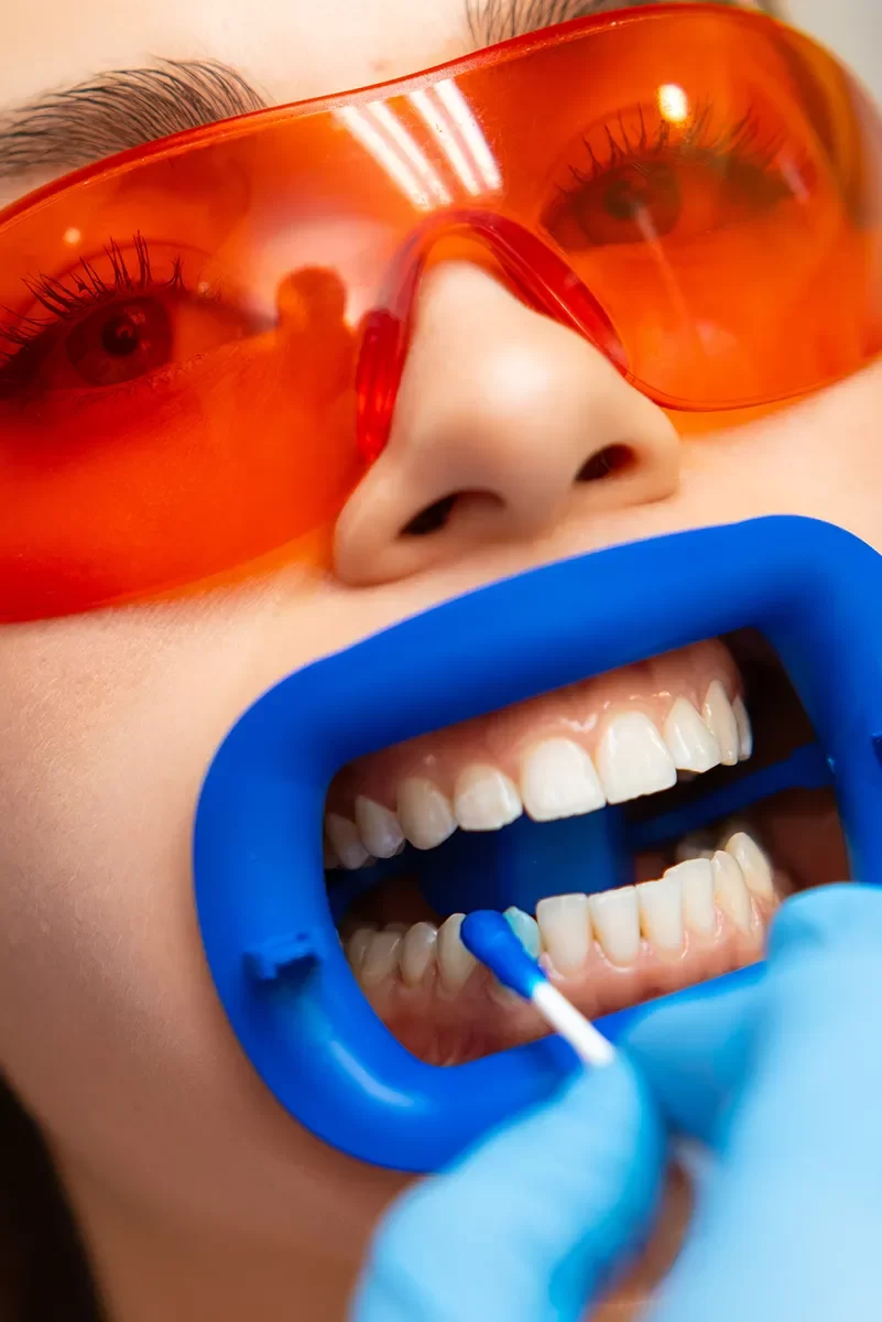 Teeth Whitening